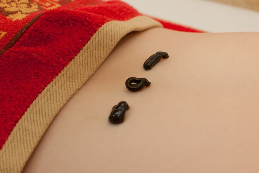 Sanguisughe nella parte bassa della schiena con osteocondrosi